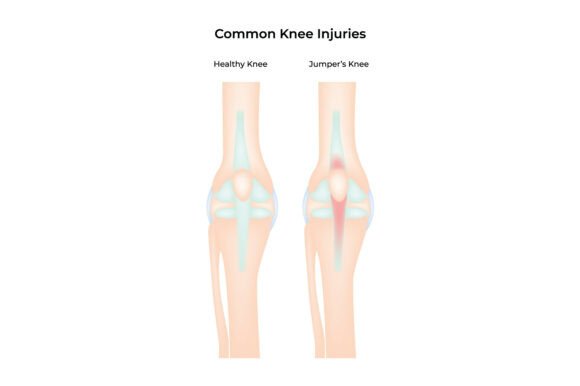 Download Common Knee Injuries Healthy Vs Jumper's - Premium Resources